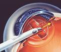 cataract2.jpg
